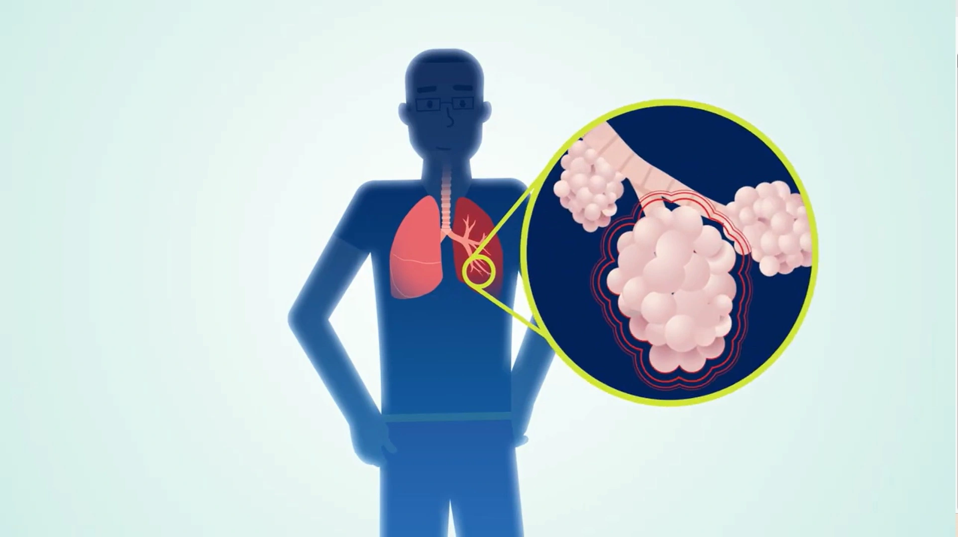 Close up of lung graphic